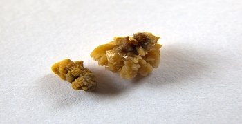 Couple of kidney stones on macro shot